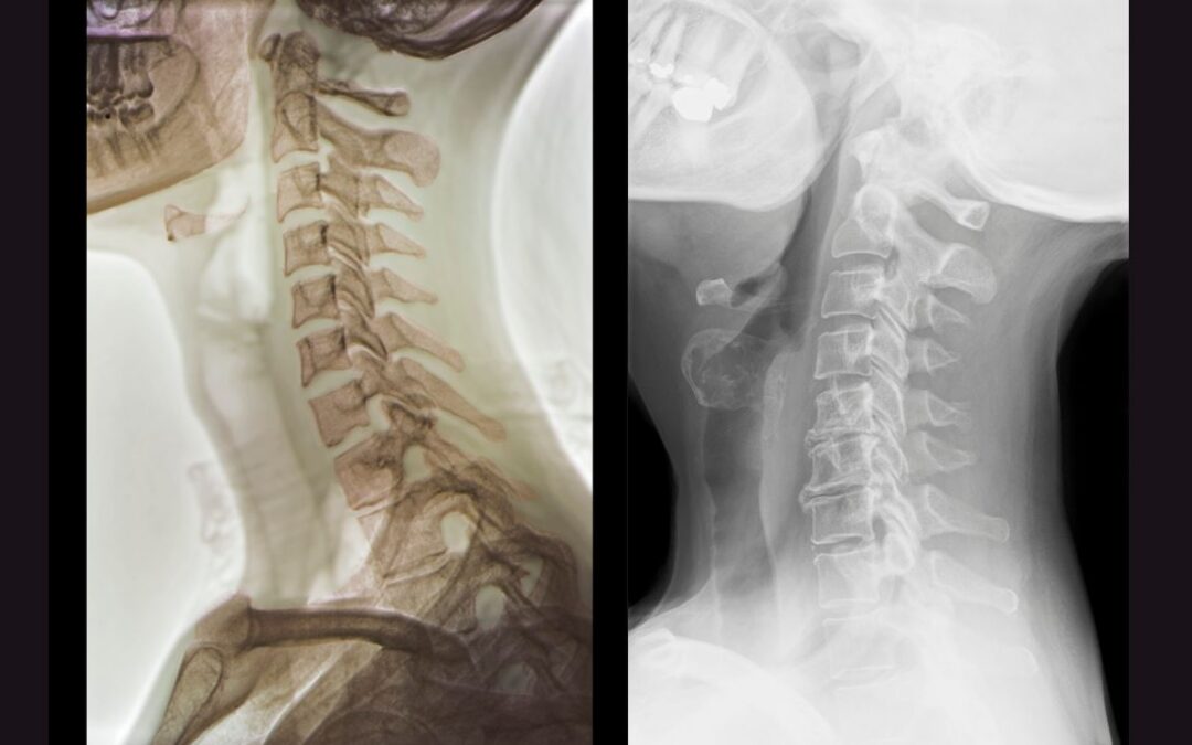 Cervical Spondylosis