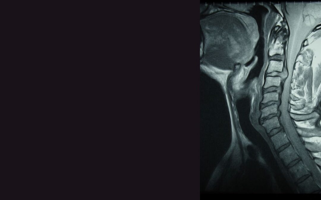 Cervical Disc Herniation