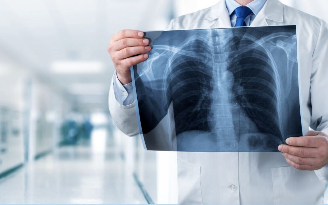 Thoracic outlet syndrome